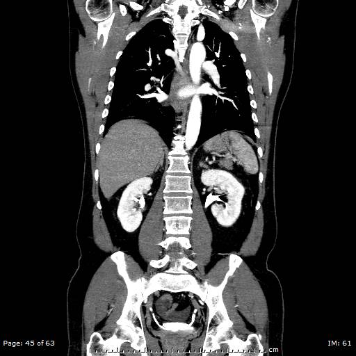 Ascending aortic aneurysm (Radiopaedia 50086-55404 B 45).jpg