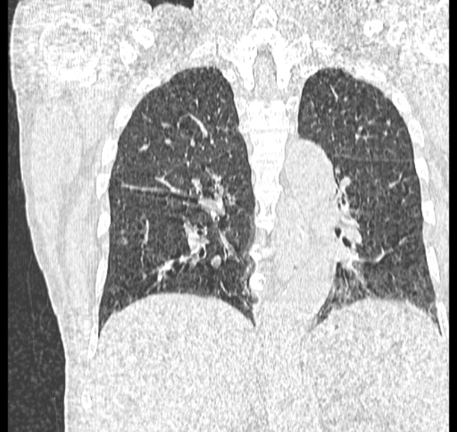 Aspergilloma (Radiopaedia 44592-48327 Coronal lung window 85).jpg