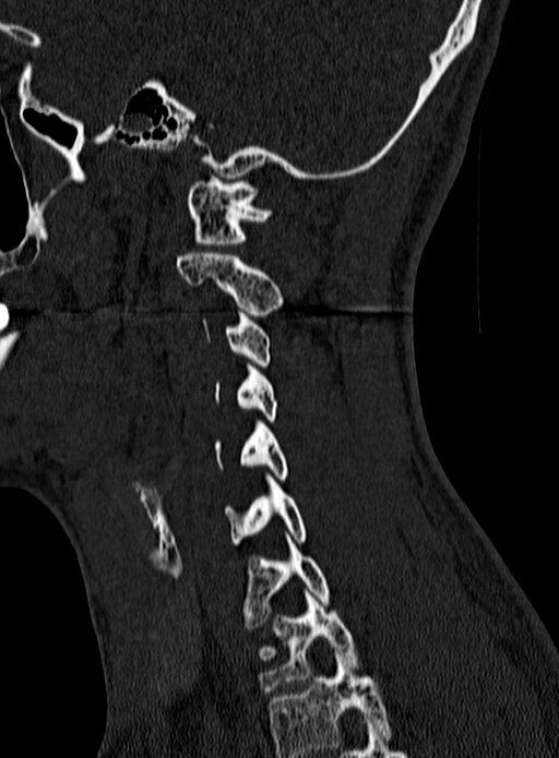 Atlantoaxial subluxation (Radiopaedia 44681-48450 Sagittal bone window 127).jpg