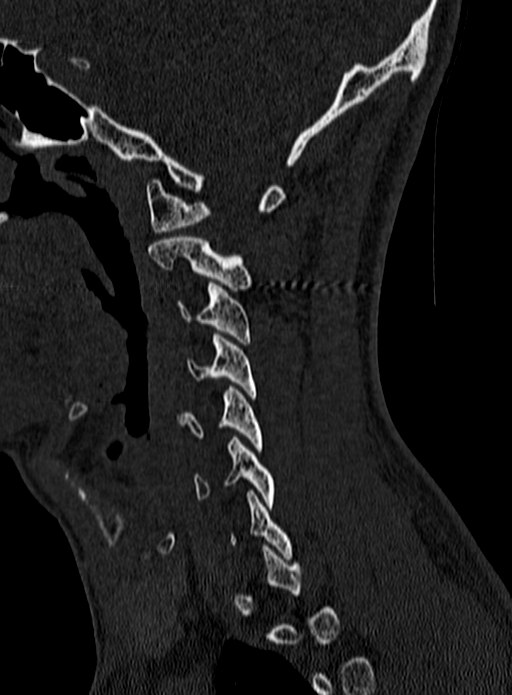 Atlantoaxial subluxation (Radiopaedia 44681-48450 Sagittal bone window 19).jpg
