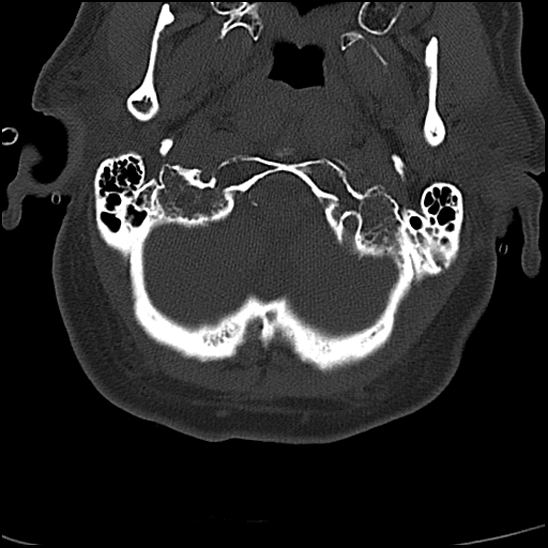 File:Atlas (type 3b subtype 1) and axis (Anderson and D'Alonzo type 3, Roy-Camille type 2) fractures (Radiopaedia 88043-104607 Axial bone window 8).jpg