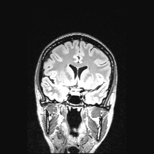 Atretic encephalocoele with inferior vermis hypoplasia (Radiopaedia 30443-31108 Coronal FLAIR 115).jpg