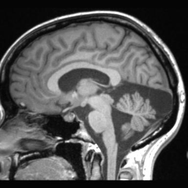 Atretic encephalocoele with inferior vermis hypoplasia (Radiopaedia 30443-31108 Sagittal T1 68).jpg