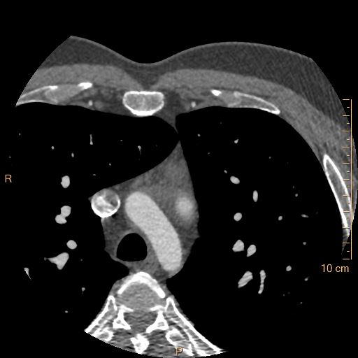 Atrial septal defect (upper sinus venosus type) with partial anomalous pulmonary venous return into superior vena cava (Radiopaedia 73228-83961 A 9).jpg