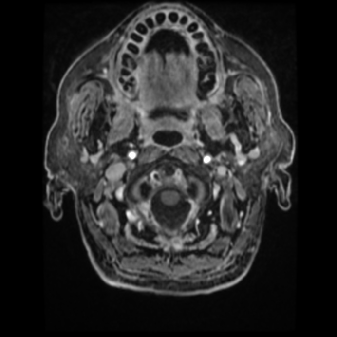 Atypical meningioma (Radiopaedia 45535-49629 Axial T1 C+ 14).jpg
