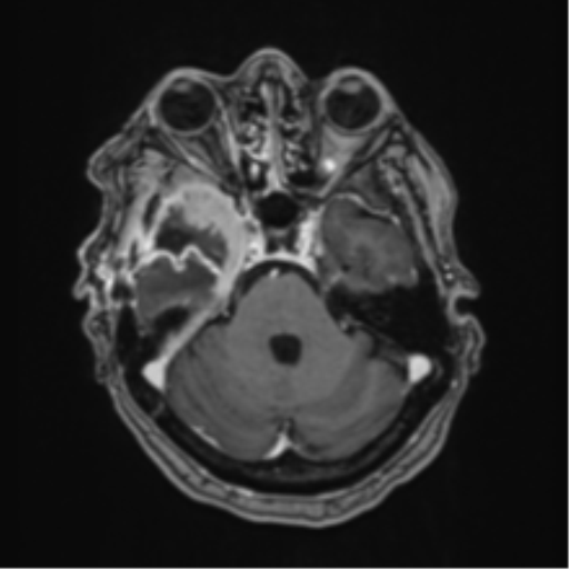 Atypical meningioma (WHO Grade II) (Radiopaedia 54742-60981 Axial T1 C+ 19).png