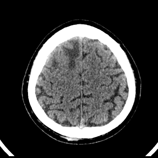 File:Atypical meningioma (WHO grade II) with brain invasion (Radiopaedia 57767-64728 Axial non-contrast 36).png