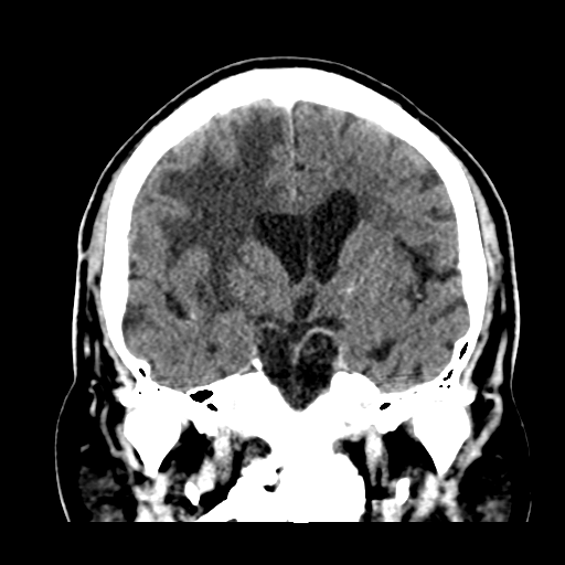 Atypical meningioma (WHO grade II) with brain invasion (Radiopaedia 57767-64728 Coronal C+ 30).png