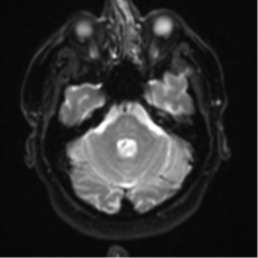 Atypical meningioma (WHO grade II) with brain invasion (Radiopaedia 57767-64729 Axial DWI 8).png