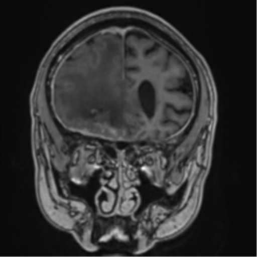 Atypical meningioma (WHO grade II) with brain invasion (Radiopaedia 57767-64729 Coronal T1 C+ 21).png