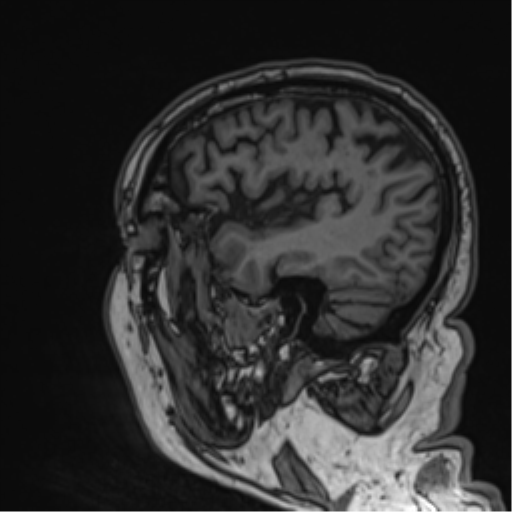 File:Atypical meningioma (WHO grade II) with brain invasion (Radiopaedia 57767-64729 Sagittal T1 21).png