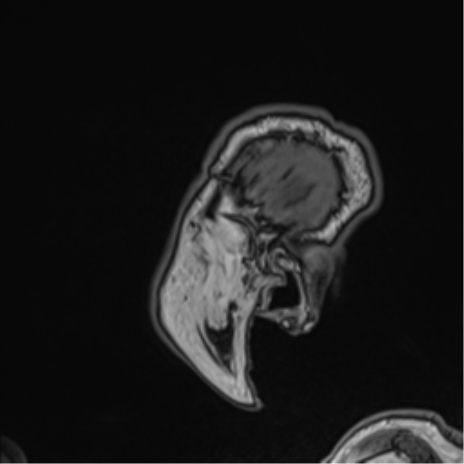 Atypical meningioma (WHO grade II) with brain invasion (Radiopaedia 57767-64729 Sagittal T1 62).png