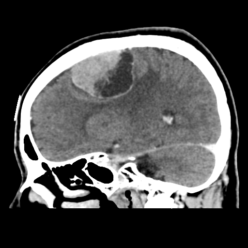 File:Atypical meningioma (WHO grade II) with osseous invasion (Radiopaedia 53654-59715 G 21).png