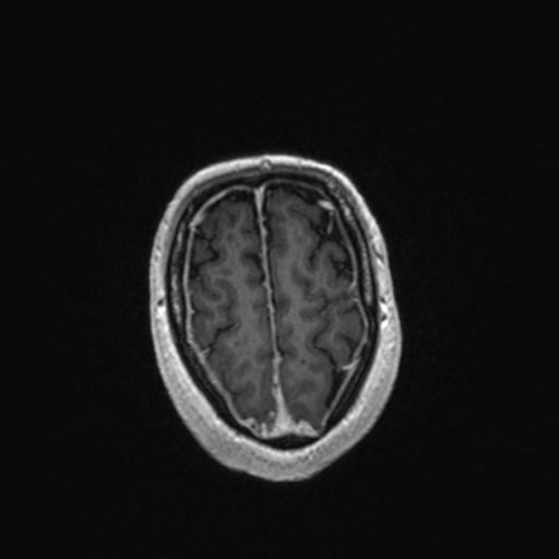 Atypical meningioma (grade II) - en plaque (Radiopaedia 29633-30147 Axial T1 C+ 156).jpg
