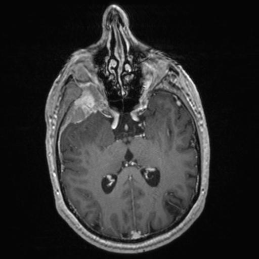 Atypical meningioma (grade II) - en plaque (Radiopaedia 29633-30147 Axial T1 C+ 89).jpg
