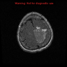 File:Atypical meningioma - grade II (Radiopaedia 13303-13305 Axial FLAIR 19).jpg