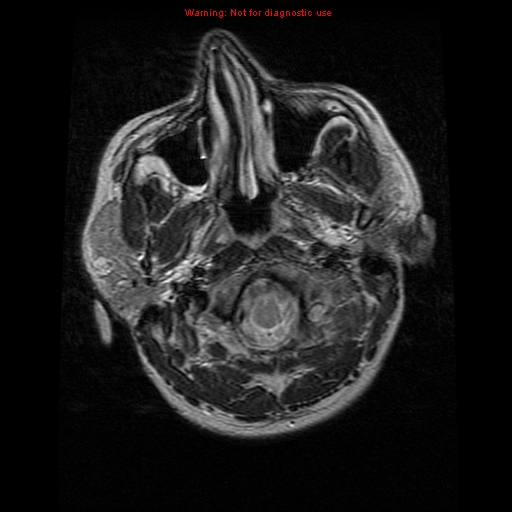 File:Atypical meningioma - grade II (Radiopaedia 13303-13305 Axial T2 2).jpg