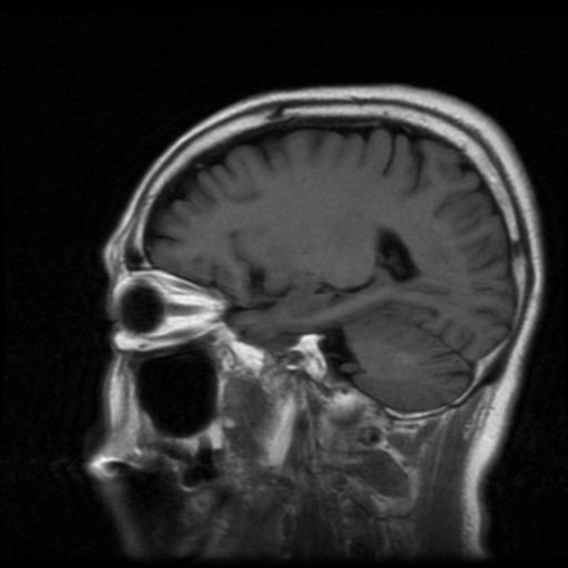 File:Atypical meningioma with skull invasion (Radiopaedia 34357-35648 Sagittal T1 8).png