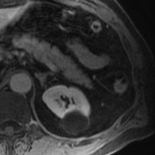 File:Atypical renal cyst on MRI (Radiopaedia 17349-17046 D 8).jpg