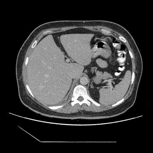 File:Atypical retroperitoneal lymphocoeles with large leiomyoma of uterus (Radiopaedia 32084-33024 A 12).jpg