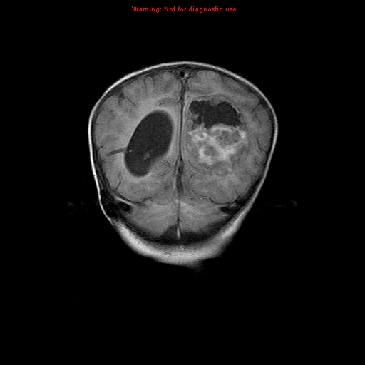 File:Atypical teratoid rhabdoid tumor (Radiopaedia 10712-11183 Coronal FLAIR 5).jpg