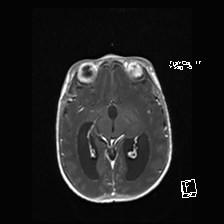 Atypical teratoid rhabdoid tumor (prenatal US and neonatal MRI) (Radiopaedia 59091-66388 Axial T1 C+ 29).jpg