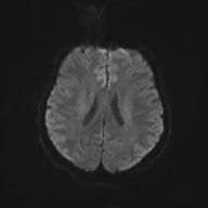 Autoimmune limbic encephalitis (Radiopaedia 30363-31005 Axial B0 and DWI 52).jpg