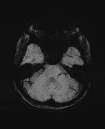 Autoimmune limbic encephalitis (Radiopaedia 30363-31005 SWI - mIP 19).jpg