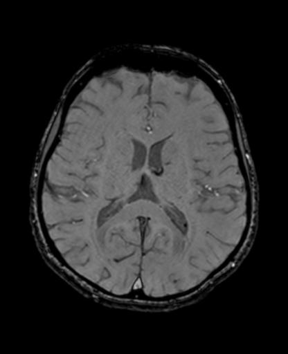 Autoimmune limbic encephalitis (Radiopaedia 30363-31005 SWI - magnitude 45).jpg