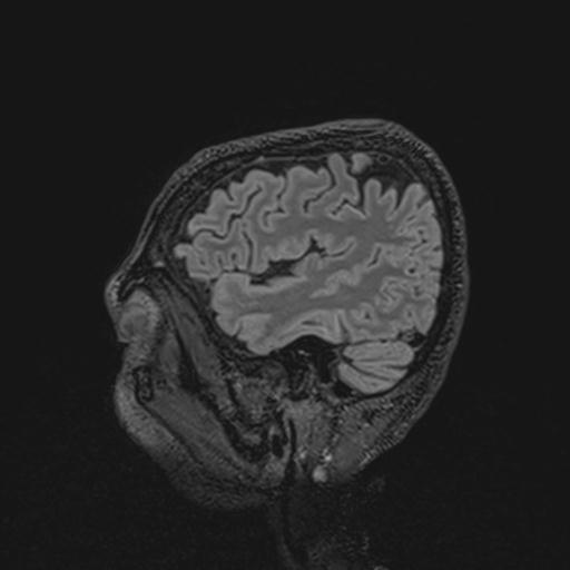 Autoimmune limbic encephalitis (Radiopaedia 30363-31005 Sagittal FLAIR 124).jpg