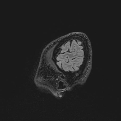 Autoimmune limbic encephalitis (Radiopaedia 30363-31005 Sagittal FLAIR 141).jpg