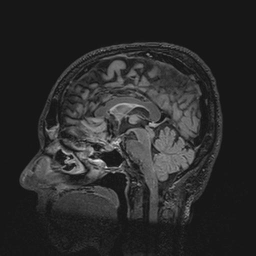 Autoimmune limbic encephalitis (Radiopaedia 30363-31005 Sagittal FLAIR 80).jpg