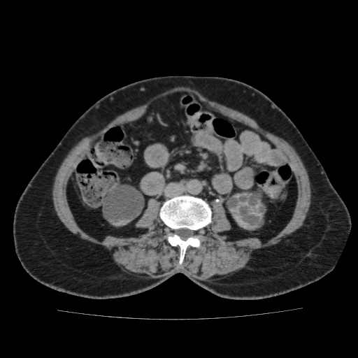 Autosomal dominant polycystic kidney disease (Radiopaedia 38189-40194 Axial C+ delayed 29).jpg