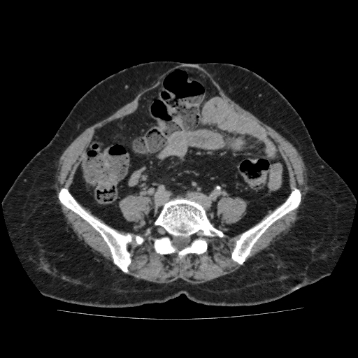 File:Autosomal dominant polycystic kidney disease (Radiopaedia 38189-40194 Axial C+ delayed 38).jpg