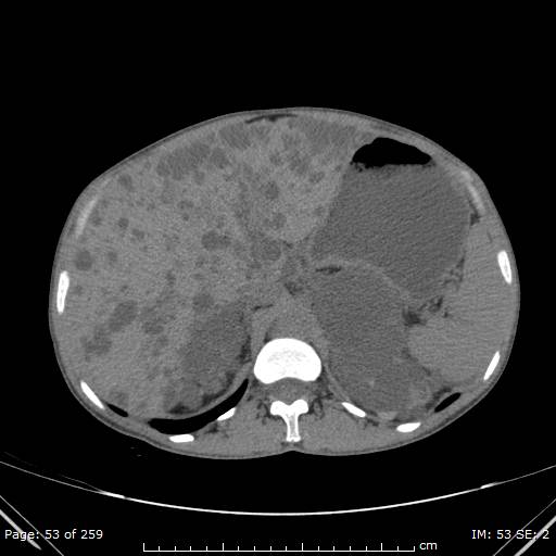 File:Autosomal dominant polycystic kidney disease (Radiopaedia 44122-47684 Axial 57).jpg