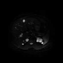 Autosomal dominant polycystic kidney disease (Radiopaedia 50259-55611 Axial DWI 14).jpg
