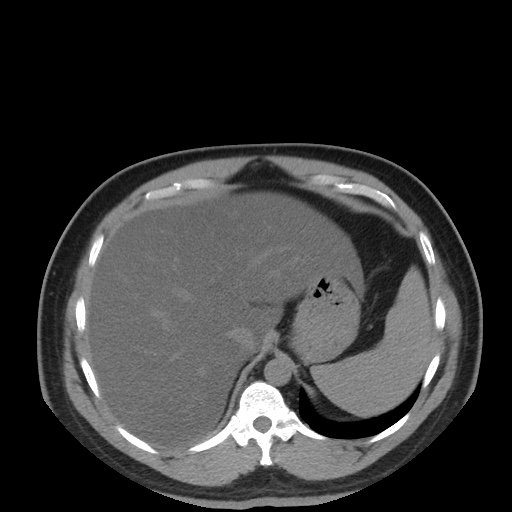 Autosomal dominant polycystic kidney disease (Radiopaedia 50259-55612 Axial non-contrast 20).jpg