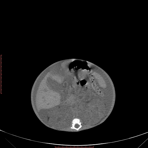 File:Autosomal recessive polycystic kidney disease associated with Caroli disease (Radiopaedia 61932-69984 Axial non-contrast 196).jpg