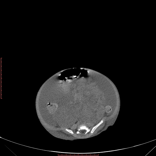Autosomal recessive polycystic kidney disease associated with Caroli disease (Radiopaedia 61932-69984 Axial non-contrast 269).jpg