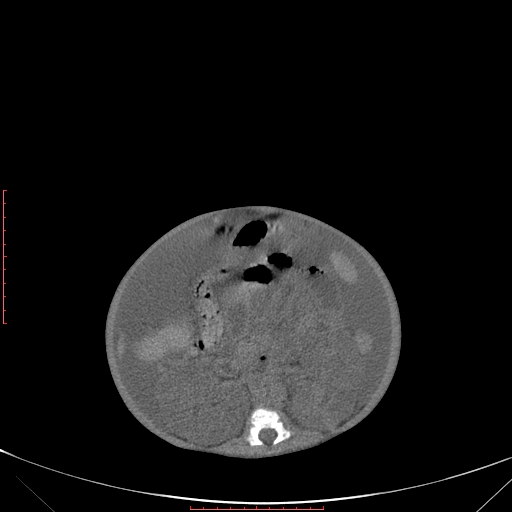 File:Autosomal recessive polycystic kidney disease associated with Caroli disease (Radiopaedia 61932-69984 B 215).jpg