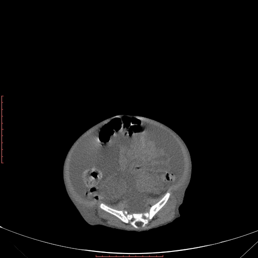File:Autosomal recessive polycystic kidney disease associated with Caroli disease (Radiopaedia 61932-69984 B 292).jpg