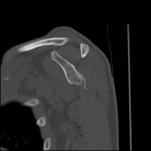 File:Avascular necrosis after fracture dislocations of the proximal humerus (Radiopaedia 88078-104653 Sagittal bone window 40).jpg