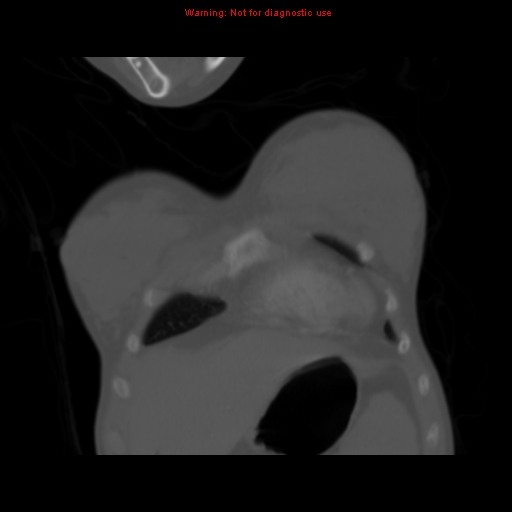 Avascular necrosis in sickle cell disease (Radiopaedia 17448-17152 Coronal bone window 16).jpg