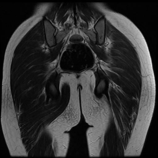File:Avascular necrosis of the hip (Radiopaedia 29563-30067 Coronal T2 16).jpg