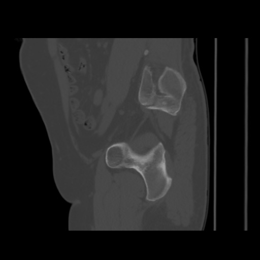 File:Avascular necrosis of the hip (Radiopaedia 61503-69467 B 21).jpg