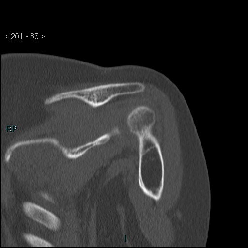 Avascular necrosis of the shoulder - Cruess stage I (Radiopaedia 77674-89887 Coronal bone window 64).jpg