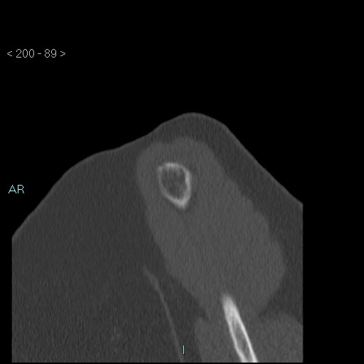 Avascular necrosis of the shoulder - Cruess stage I (Radiopaedia 77674-89887 Sagittal bone window 88).jpg