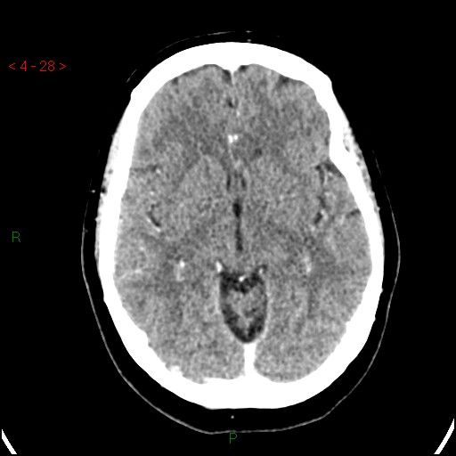 Azygos anterior cerebral artery (Radiopaedia 51987-57833 A 28).jpg
