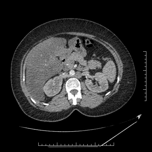 File:Azygos continuation of the IVC (Radiopaedia 40416-42965 A 30).jpg