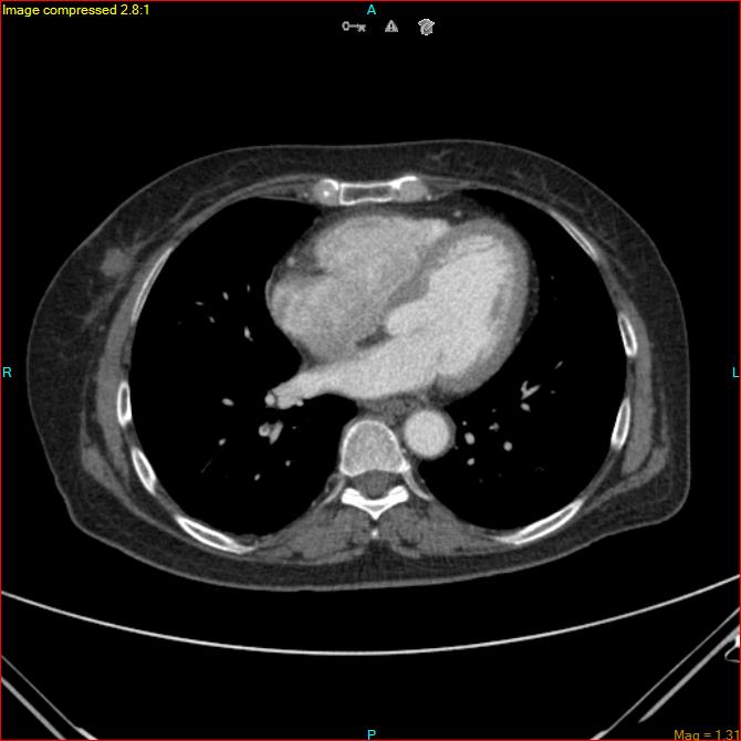 Azygos vein aneurysm (Radiopaedia 77824-90130 B 37).jpg